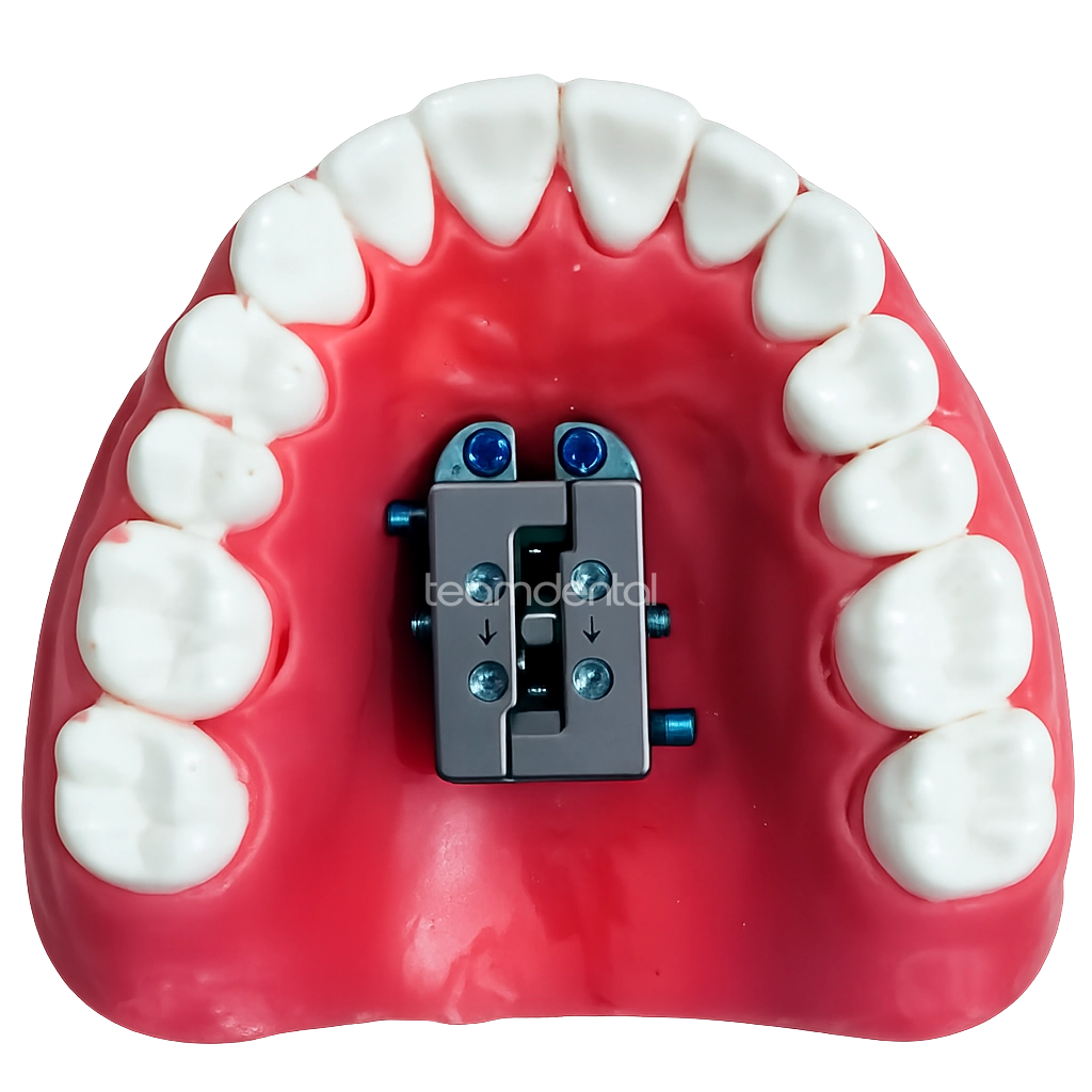 FME Expander - Facegenics Midface Expander palatal device