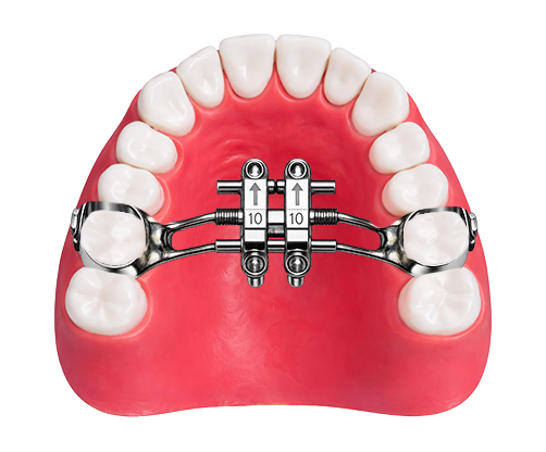 MSE Expander - Maxillary Skeletal Expander palatal device